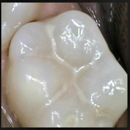 after dental tooth sealants | dental hygiene for all mississauga