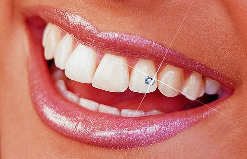 swarovski tooth jewel installation mississauga